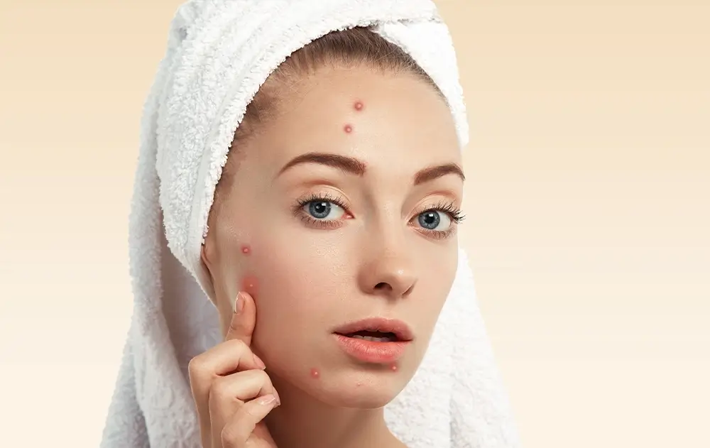 acne o erro mais comum que vejo nas consultas