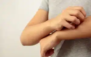 como reconhecer a psoriase