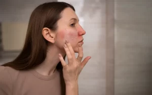 dermatite na face 3 gatilhos que podem estar piorando sua pele