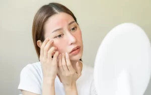 dermatite perioral