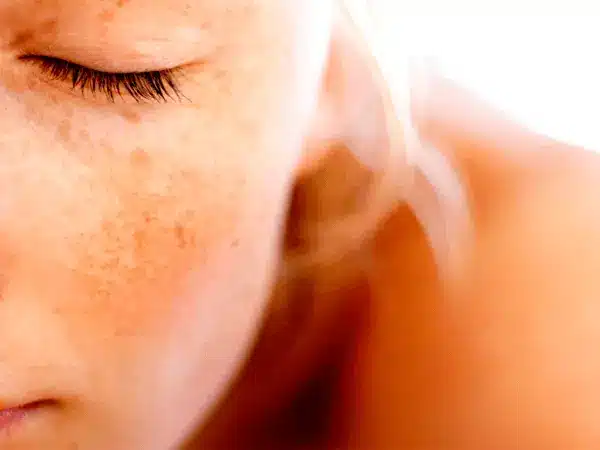 imagem de melasma