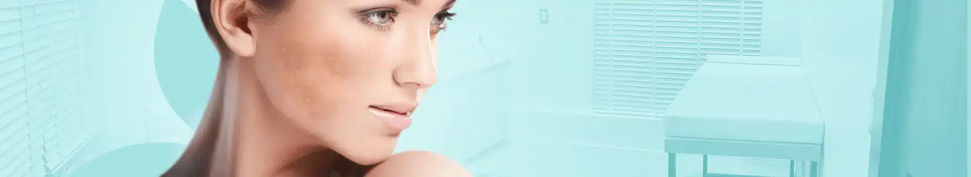 topo melasma
