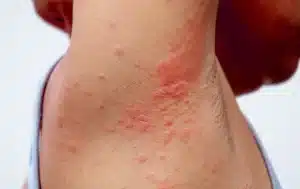 urticaria