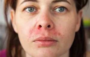 Dermatite Perioral 5 informações que podem mudar a forma como você entende essa doença