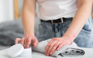 Quem tem dermatite ou psoríase pode fazer procedimentos estéticos