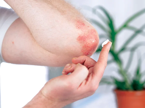 image psoriase